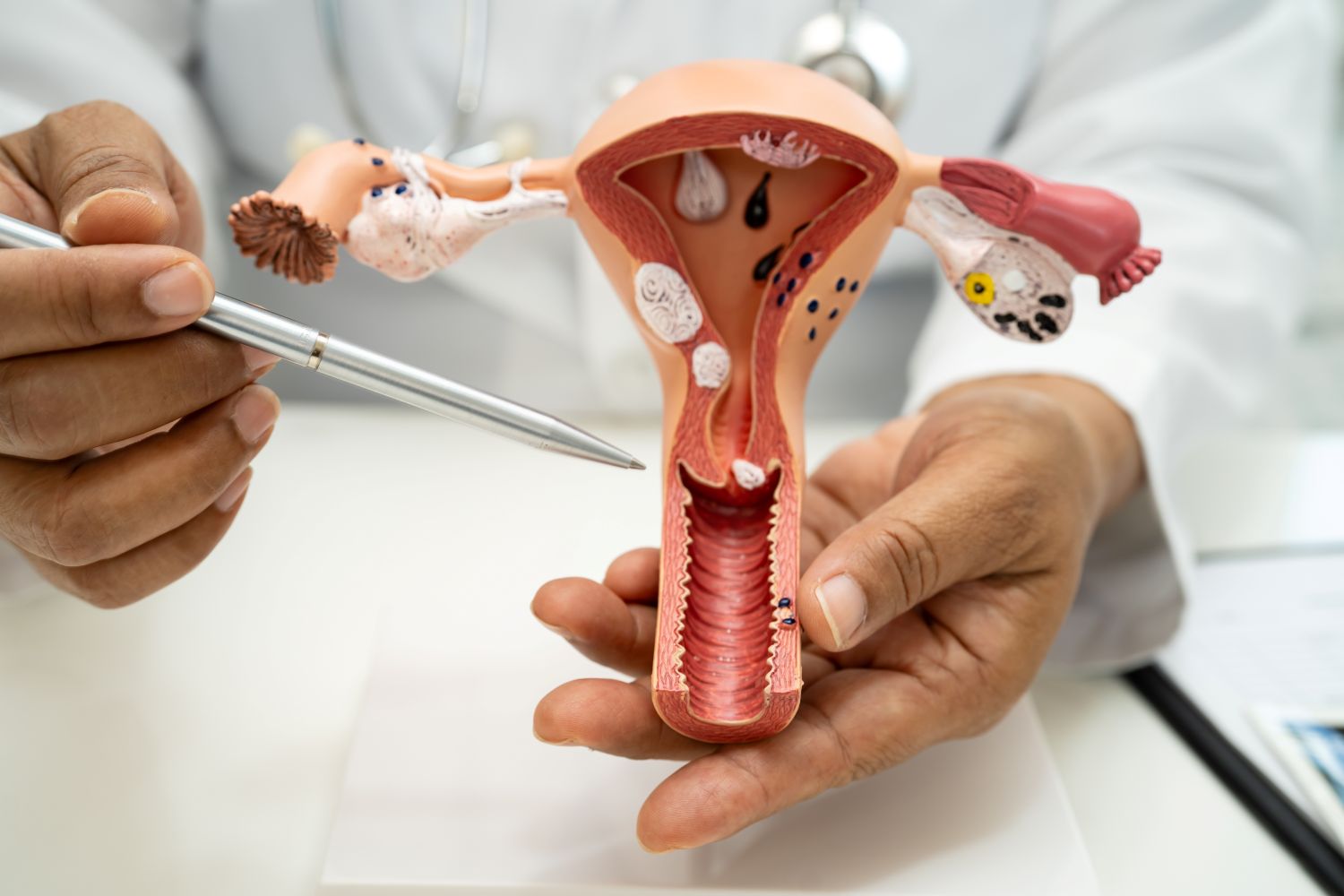 Cervical cancer